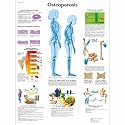3B Scientific VR3121L Glossy UV Resistant Laminated Paper Osteoporosis Anatomical Chart (Osteoporosis Anatomical Chart, Spanish), Poster Size 20" Width x 26" Height