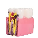 Dental Caries Teeth Model,Dental Anatomy Education Tooth Model,6 Times Caries Teaching Typodont Tool for Dentists, Patients, Teachers and Students