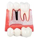 Dental Implant Model - 4 Times Crown Bridge Explanation Model Implant Analysis Tooth Model Removable Crown Cross-Section Demonstration for Study and Teaching