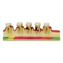 Lab Periodontal Disease Assort Tooth Typodont Teeth Model Study Teach 5-Stage Perio Disease Assort Demo (4010)