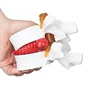 Disc Herniation Model - 1.5X Lumbar Herniated Disc Model Vertebral Spine Anatomical Medical Model