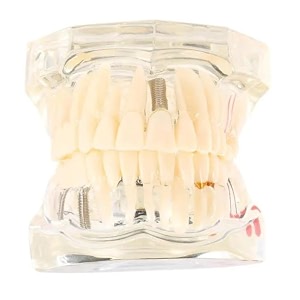 identical all in one dental implant model m2001 white demonstration model for implant training prosthodontic education surgical planning and patient explanation