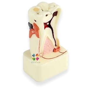 identical dental model for 4x pathologies of tooth m4015  educational tool for dental students amp professionals  accurate anatomy amp detailed representation of common dental pathologies