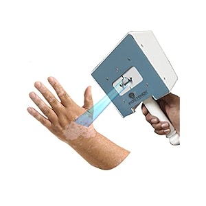 spot nbuvb phototherapy device treatment for psoriasis vitiligo adjustable spot openingtargeted exposure