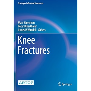 knee fractures strategies in fracture treatments