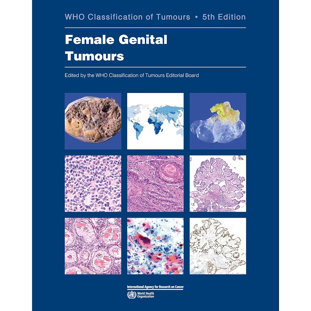 WHO classification of female genital tumours: Who Classification of ...